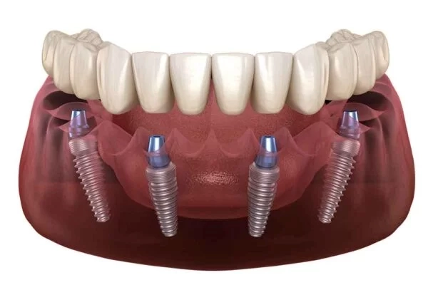 All-on-4-system-supported-by-implants-front-view-1000x667-1-600x400