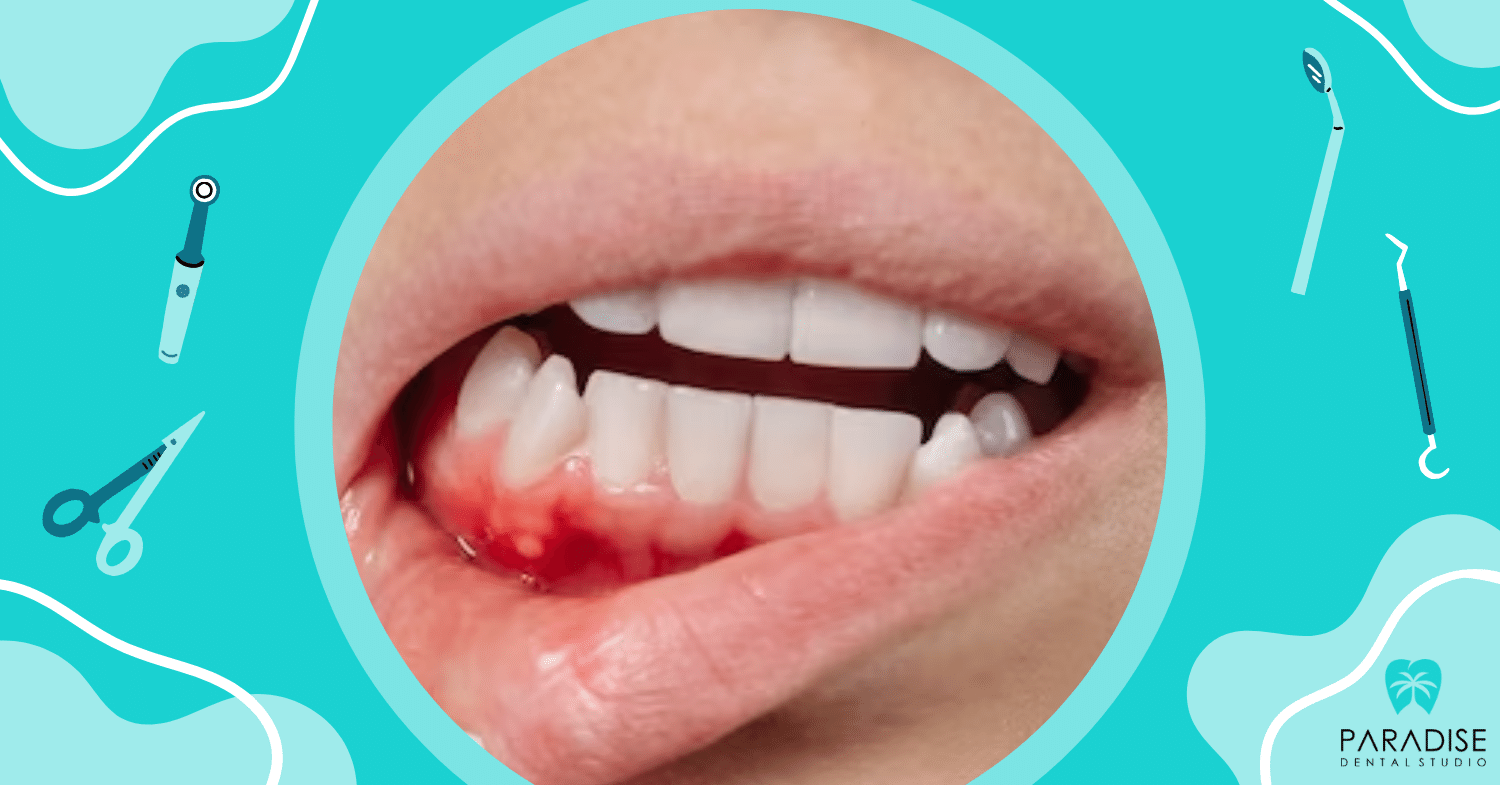 Bleeding Gums: Causes, Treatments, And When To See A Dentist