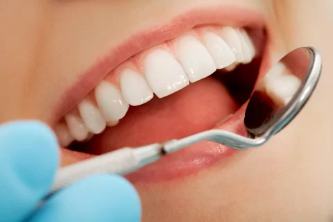 close up of white smile with dental exam mirror