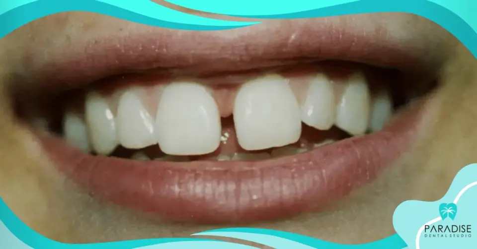 Gapped Teeth (Diastema) Cosmetic Solutions for a Beautiful Smile