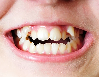 Impacted Teeth | Crooked Teeth