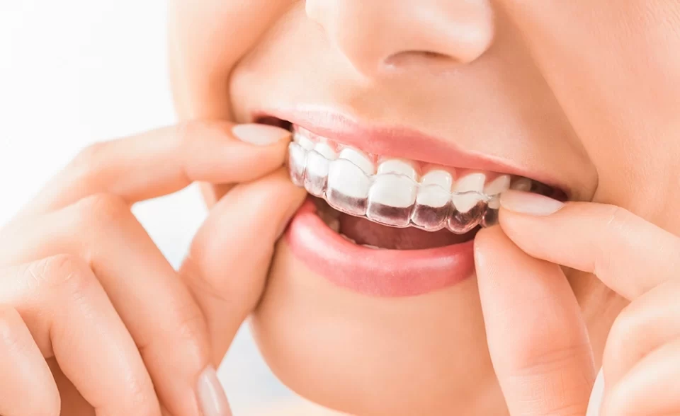 Crooked Teeth