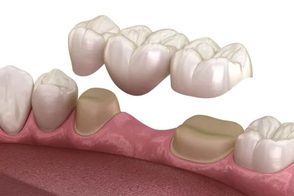 dental-bridge-of-3-teeth-over-molar-and-premolar-1500x1000-1-600x400