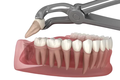 diagram of wisdom tooth extraction