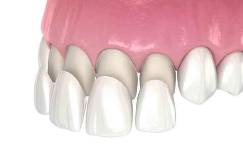 mock-up of dental veneers over natural teeth