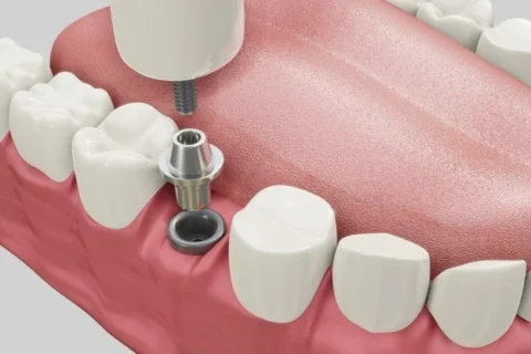 single dental implant