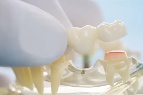 stock photo of dental bridges concept