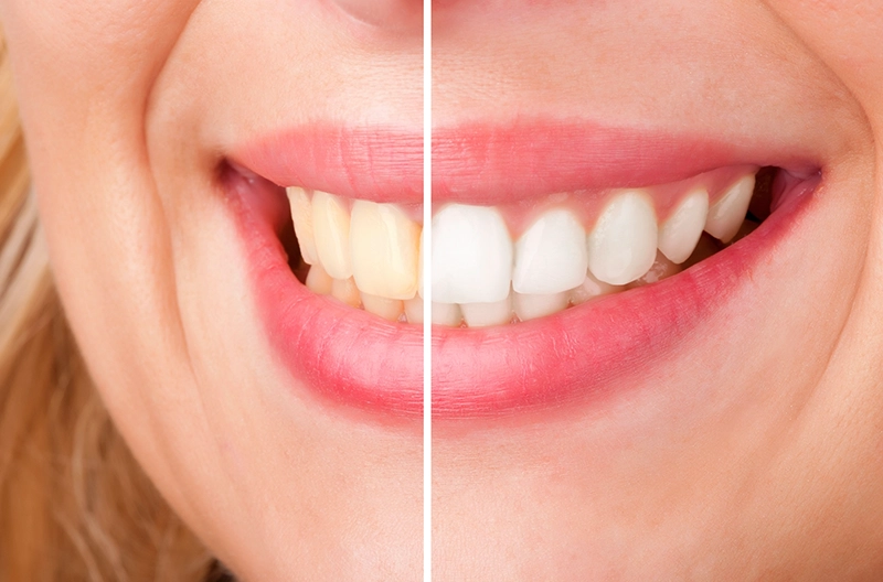 teeth whitening | Teeth discoloration